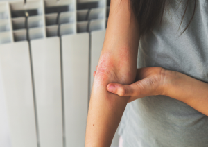 DERMATITIS