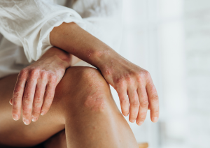 PSORIASIS