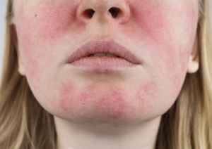 ROSACEA