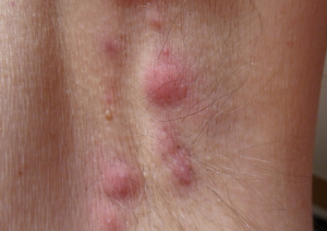 hidradenitis