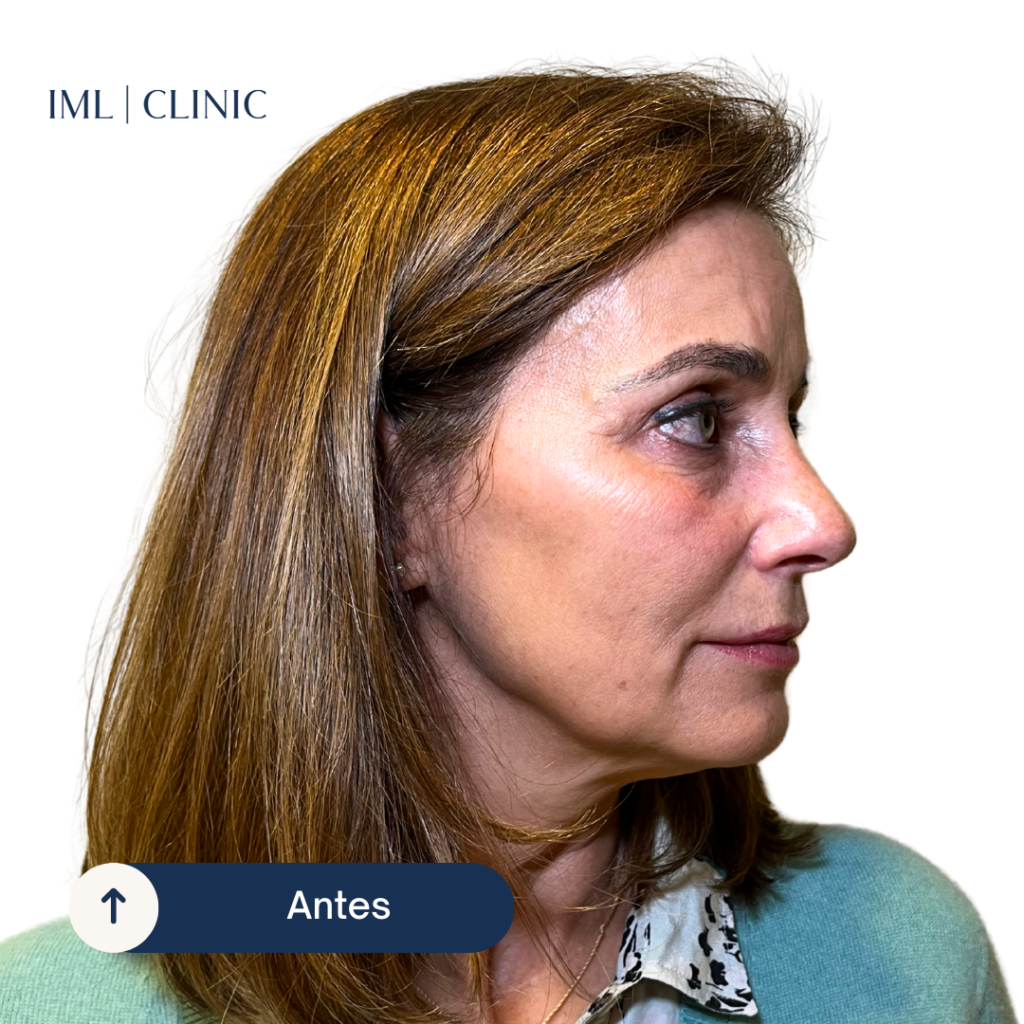 antes