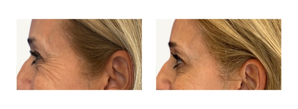 arrugas patas de gallo